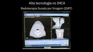 Alta tecnologia no INCA
Radioterapia Guiada por Imagem (IGRT)
 