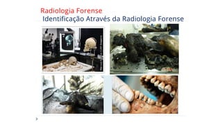 Radiologia Forense
Identificação Através da Radiologia Forense
 