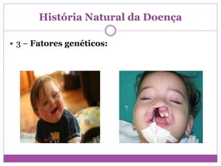História Natural da Doença
 3 – Fatores genéticos:
 