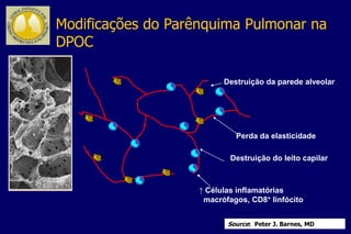 Destruição da parede alveolar
Perda da elasticidade
Destruição do leito capilar
↑ Células inflamatórias
macrófagos, CD8+ linfócito
Source: Peter J. Barnes, MD
Modificações do Parênquima Pulmonar na
DPOC
 