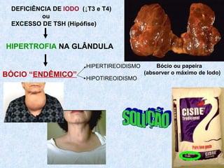 HIPERTROFIA  NA GLÂNDULA Bócio ou papeira (absorver o máximo de Iodo) DEFICIÊNCIA DE  IODO   (↓T3 e T4) ou EXCESSO DE TSH (Hipófise) SOLUÇÃO BÓCIO “ ENDÊMICO”   HIPERTIREOIDISMO HIPOTIREOIDISMO 