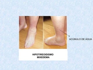 HIPOTIREOIDISMO  MIXEDEMA ACÚMULO DE ÁGUA 