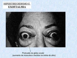 HIPERTIREOIDISMO E  EXOFTALMIA Protrusão do globo ocular  (aumento de músculos e tecidos na órbita do olho) 