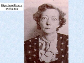 Hipertireoidismo e  exoftalmia 