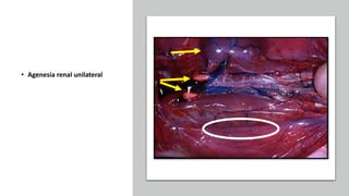 • Agenesia renal unilateral
 