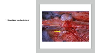 • Hipoplasia renal unilateral
 