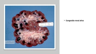 • Congestão renal ativa
 