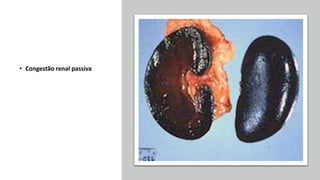 • Congestão renal passiva
 