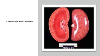 • Hemorragia renal - petéquias
 