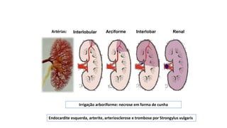 Endocardite esquerda, arterite, arteriosclerose e trombose por Strongylus vulgaris
Interlobular Arciforme Interlobar Renal
Irrigação arboriforme: necrose em forma de cunha
Artérias:
 