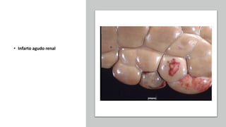 • Infarto agudo renal
 