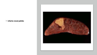 • Infarto renal pálido
 