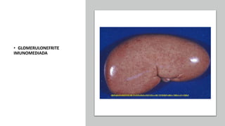 • GLOMERULONEFRITE
IMUNOMEDIADA
 