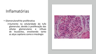 Inflamatórias
• Glomerulonefrite proliferativa
Aumento na celularidade do tufo
glomerular, devido à proliferação das
células glomerulares e influxo
de leucócitos, envolvendo tanto
as alças capilares como o mesângio
 