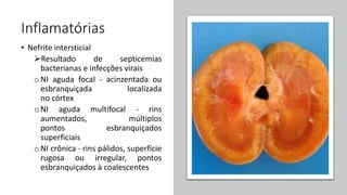 Inflamatórias
• Nefrite intersticial
Resultado de septicemias
bacterianas e infecções virais
oNI aguda focal - acinzentada ou
esbranquiçada localizada
no córtex
oNI aguda multifocal - rins
aumentados, múltiplos
pontos esbranquiçados
superficiais
oNI crônica - rins pálidos, superfície
rugosa ou irregular, pontos
esbranquiçados à coalescentes
 