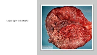 • Cistite aguda com enfisema
 