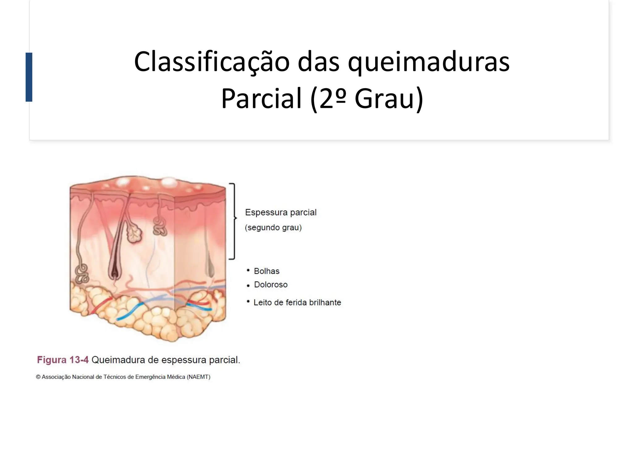 Classificação das queimaduras
Parcial (2º Grau)
 