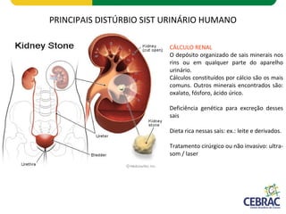PRINCIPAIS DISTÚRBIO SIST URINÁRIO HUMANO
CÁLCULO RENAL
O depósito organizado de sais minerais nos
rins ou em qualquer parte do aparelho
urinário.
Cálculos constituídos por cálcio são os mais
comuns. Outros minerais encontrados são:
oxalato, fósforo, ácido úrico.
Deficiência genética para excreção desses
sais
Dieta rica nessas sais: ex.: leite e derivados.
Tratamento cirúrgico ou não invasivo: ultra-
som / laser
 