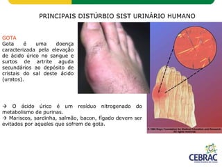 PRINCIPAIS DISTÚRBIO SIST URINÁRIO HUMANO
GOTA
Gota é uma doença
caracterizada pela elevação
de ácido úrico no sangue e
surtos de artrite aguda
secundários ao depósito de
cristais do sal deste ácido
(uratos).
 O ácido úrico é um resíduo nitrogenado do
metabolismo de purinas.
 Mariscos, sardinha, salmão, bacon, fígado devem ser
evitados por aqueles que sofrem de gota.
 