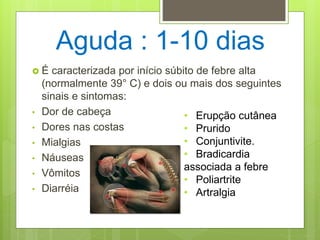 Aguda : 1-10 dias
 É caracterizada por início súbito de febre alta
(normalmente 39° C) e dois ou mais dos seguintes
sinais e sintomas:
• Dor de cabeça
• Dores nas costas
• Mialgias
• Náuseas
• Vômitos
• Diarréia
• Erupção cutânea
• Prurido
• Conjuntivite.
• Bradicardia
associada a febre
• Poliartrite
• Artralgia
 