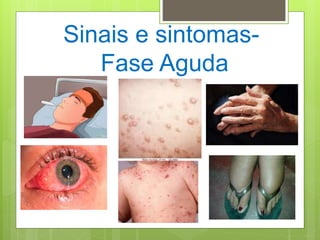 Sinais e sintomas-
Fase Aguda
 