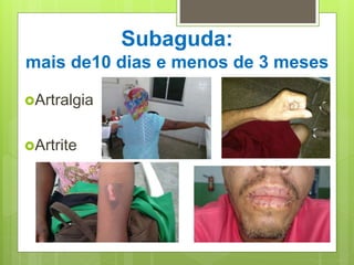 Subaguda:
mais de10 dias e menos de 3 meses
Artralgia
Artrite
 