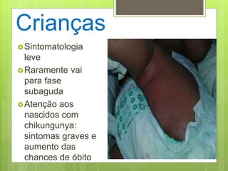 Crianças
Sintomatologia
leve
Raramente vai
para fase
subaguda
Atenção aos
nascidos com
chikungunya:
sintomas graves e
aumento das
chances de óbito
 
