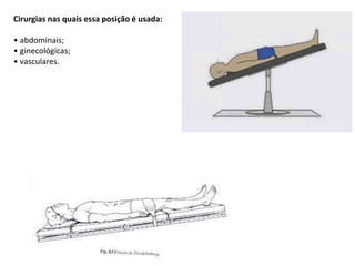 Cirurgias nas quais essa posição é usada:
• abdominais;
• ginecológicas;
• vasculares.
 