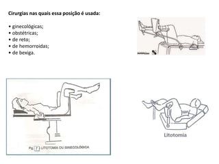 Cirurgias nas quais essa posição é usada:
• ginecológicas;
• obstétricas;
• de reto;
• de hemorroidas;
• de bexiga.
 