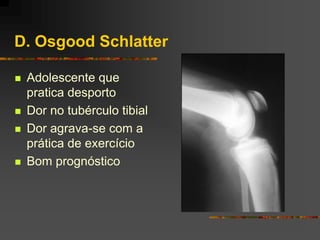 D. Osgood Schlatter

   Adolescente que
    pratica desporto
   Dor no tubérculo tibial
   Dor agrava-se com a
    prática de exercício
   Bom prognóstico
 