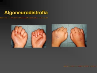 Algoneurodistrofia
 