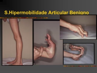 S.Hipermobilidade Articular Benigno
 