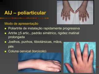 AIJ – poliarticular

Modo de apresentação
 Poliartrite de instalação rapidamente progressiva

 Artrite >5 artic., padrão simétrico, rigidez matinal
  prolongada
 Joelhos, punhos, tibiotársicas, mãos,

  pés
 Coluna cervical (torcicolo)
 