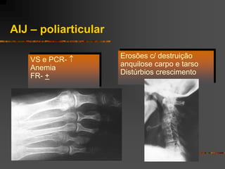 AIJ – poliarticular

    VS e PCR-        Erosões c/ destruição
                      anquilose carpo e tarso
    Anemia
                      Distúrbios crescimento
    FR- +
 