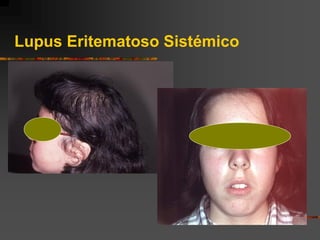 Lupus Eritematoso Sistémico
 