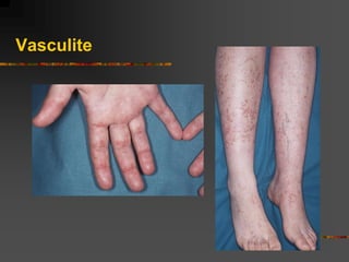 Vasculite
 