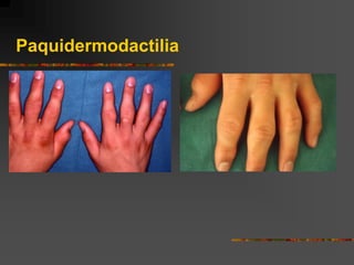 Paquidermodactilia
 