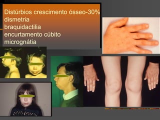 Distúrbios crescimento ósseo-30%
dismetria
braquidactilia
encurtamento cúbito
micrognátia
 