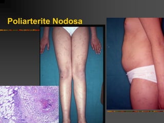 Poliarterite Nodosa
 