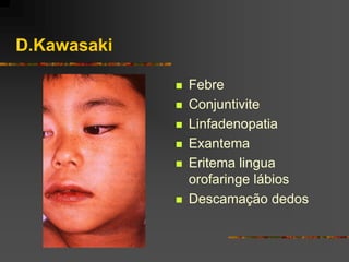 D.Kawasaki

                Febre
                Conjuntivite
                Linfadenopatia
                Exantema
                Eritema lingua
                 orofaringe lábios
                Descamação dedos
 