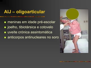AIJ – oligoarticular

   meninas em idade pré-escolar
   joelho, tibiotársica e cotovelo
   uveíte crónica assintomática
   anticorpos antinucleares no soro
 