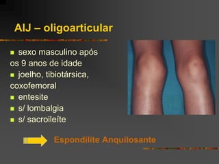 AIJ – oligoarticular

 sexo masculino após
os 9 anos de idade
 joelho, tibiotársica,
coxofemoral
 entesite
 s/ lombalgia
 s/ sacroileíte


           Espondilite Anquilosante
 