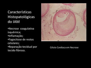 Célula Cardíaca em Necrose
Características
Histopatológicas
do IAM
•Necrose coagulativa
isquêmica;
•Inflamação;
•Fagocitose de restos
celulares;
•Reparação tecidual por
tecido fibroso.
 
