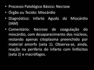 • Processo Patológico Básico: Necrose
• Órgão ou Tecido: Miocárdio
• Diagnóstico: Infarto Agudo do Miocárdio
(IAM)
• Comentário: Necrose de coagulação do
miocárdio, com desaparecimento dos núcleos,
restando apenas citoplasma preenchido por
material amorfo (seta 1). Observa-se, ainda,
reação na periferia do infarto com linfócitos
(seta 2) e macrófagos.
 