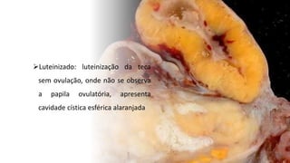 Luteinizado: luteinização da teca
sem ovulação, onde não se observa
a papila ovulatória, apresenta
cavidade cística esférica alaranjada
 