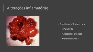 Alterações inflamatórias
• Ovarite ou ooforite – rara
Purulenta
Abscessos ováricos
Granulomatosa
 