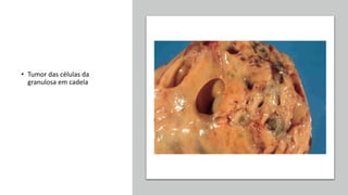 • Tumor das células da
granulosa em cadela
 