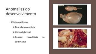 Anomalias do
desenvolvimento
• Criptorquidismo
Descida incompleta
Uni ou bilateral
Causas: hereditária ou
dominante
 