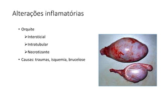 Alterações inflamatórias
• Orquite
Intersticial
Intratubular
Necrotizante
• Causas: traumas, isquemia, brucelose
 