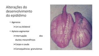 Alterações do
desenvolvimento
do epidídimo
• Agenesia
Uni ou bilateral
• Aplasia segmentar
Interrupção dos
ductos mesonéfricos
Corpo e cauda
Consequências: granulomas
 